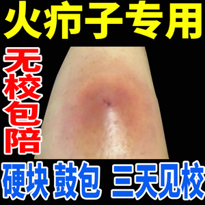 火疖子拔毒拔脓膏软膏治疗火疖子的药去除粉瘤痘痘拔毒神器