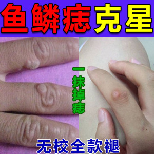 鱼鳞痣药膏扁平疣点疣血胞刺去老鼠痣肉粒疙瘩手脚长疣石克疣液
