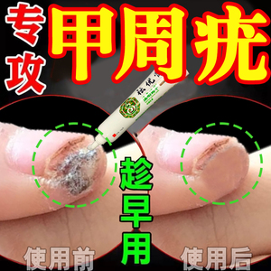 甲周疣专用药治疗去除脚底指甲下手上长疣瘊疣偏方鸭鸦胆子祛疣膏