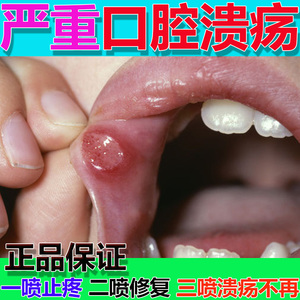 口腔溃疡专用喷剂专用药咽喉滤泡增生口腔喉咙肿痛干痒发炎神器