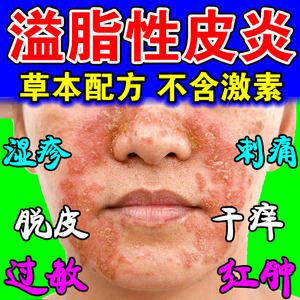脂溢性皮炎面部无激素治鼻翼头皮脸部中药去根除过敏湿疹止痒软膏