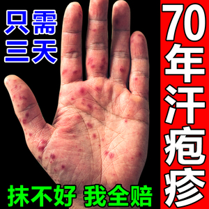 【对正用膏】汗疱疹止痒软化膏夏天身上手上出汗起小疙瘩水疱药膏