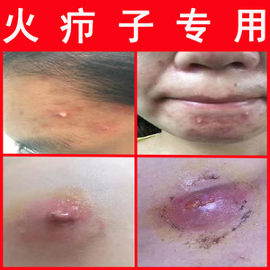 拔毒膏拔毒贴火疖子吸脓头买二送一坐板疮脓包红肿疼痘痘流脓贴膏