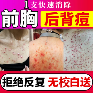 祛痘印后背女