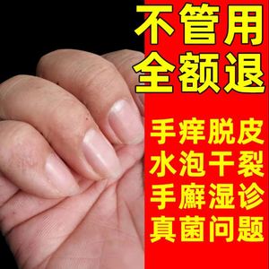 喷剂手藓药膏真菌脱皮手起水泡痒蜕皮药膏皮肤病真菌感染除螨去鲜