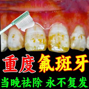 稀盐酸氟斑牙专用牙膏牙齿美白美牙仪药水牙釉质牙菌斑牙渍垢神器