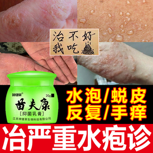 汗状疱疹手上起小水泡专用药膏止痒干裂手足藓汗疱疹真菌感染神器