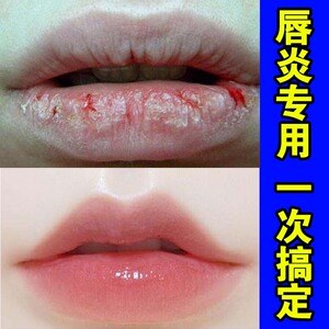 唇炎专用药唇膏修复保湿嘴唇防干裂脱皮起皮起泡口角润唇油炎儿童