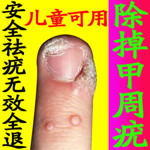 甲周疣专用药大人儿童甲下疣跖疣特效药去除足部去痣去扁平疣神器