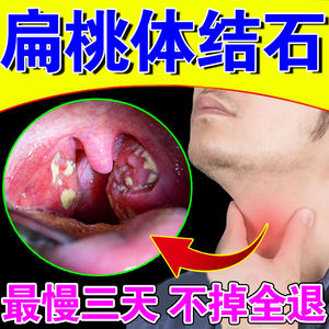 扁桃体结石去除工具漱口水清理咽喉肿痛发炎有异物感干痒结石喷剂
