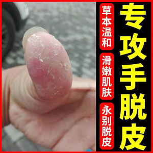 手脱皮真菌感染药膏克星脱皮干裂鹅掌风起小水泡手痒汗疱疹手藓膏
