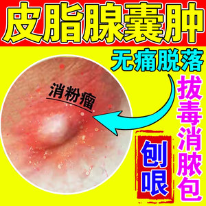 皮脂腺囊肿拔毒膏去除火疖子结节硬块粉瘤拔脓包皮下囊肿神器膏贴