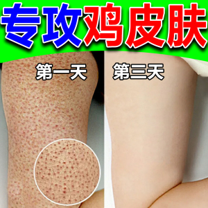 蛇皮肤鱼鳞腿部鸡皮肤疙瘩毛囊角质化药膏手臂毛周炎毛囊去除神器