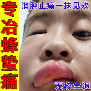 马蜂蛰伤药膏治被蜜蜂黑蜂蛰叮咬的药消红肿止痛拔毒杀菌养蜂专用
