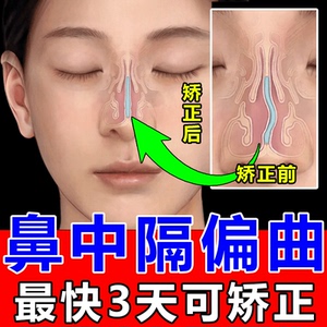 鼻中隔偏曲矫正器治疗口呼吸鼻甲肥大神器鼻支撑器鼻塞通气神器