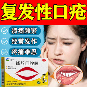 蜂胶口腔贴膜口腔溃疡专用贴清热止痛复发性口疮贴药蜂蜜口腔贴