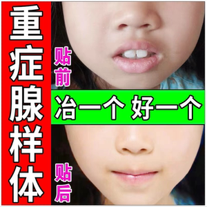 00129人付款淘宝长生祥小儿童腺样体肥大打鼾打呼噜鼻甲肥大鼻塞通