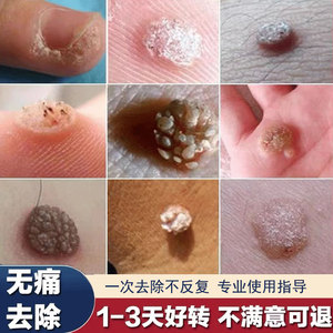 鸡眼膏贴鱼鳞痣去猴子肉粒疙瘩刺猴贴跖疣专用药肉刺贴瘊子药神器