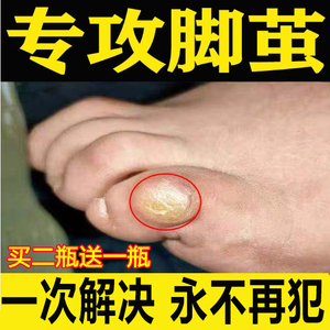 祛老茧脚茧手脚趾脚底死皮关节茧去根软化剂去除脚垫的药胼胝神器