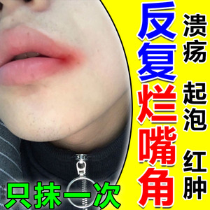 口角炎药膏烂嘴角嘴巴上火起泡干裂脱皮红肿唇炎专用口周皮炎软膏