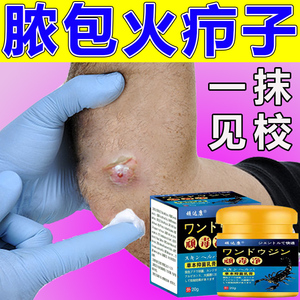 顺欣养生淘宝皮脂腺囊肿型坐板脓疮药膏火疖子拔毒拔脓贴皮下粉瘤