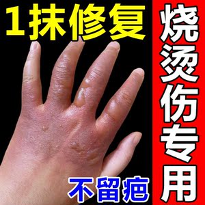烧烫伤药特效不留疤开水热油电焊火烧烫伤水泡皮肤愈合修复疤痕膏