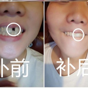 牙洞自补堵牙洞神器牙缝宽大修复神器门牙缝隙大牙缝自补牙缝凝胶