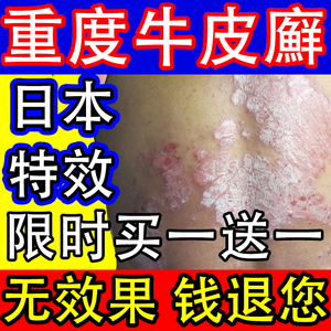 日本治疗牛皮癣药膏银屑病专用头皮手足体股藓廯湿疹皮肤止痒外用
