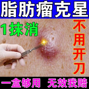 粉瘤皮脂腺囊肿膏痘痘去除腘窝囊肿脂肪瘤药膏囊肿结节性痤疮拔毒