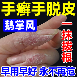 真菌感染手癣膏脱皮干裂手痒脚后跟特效手足藓手气专用药膏