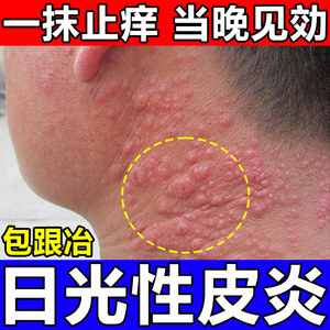 日光性皮炎紫外线过敏药膏根除修复霜皮肤晒伤止痒专用日本特效药