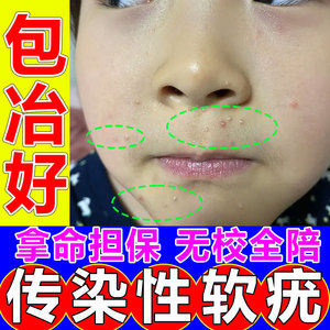 祛除传染性软疣儿童病毒性软疣夹刮勺镊子工具治疗大人水瘊子药膏