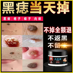 日本去痣点痣的药膏无痕正品专用药膏去猴子点痦子取痣点痣膏脸部