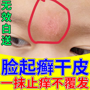 儿童脸上长癣眼皮癣脸干燥起皮脱皮过敏起癣面部眼部癣保湿修复霜