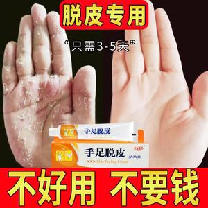 治疗手脱皮的药膏用什么严重褪皮起泡手指头尖脚底治蜕皮起皮退皮