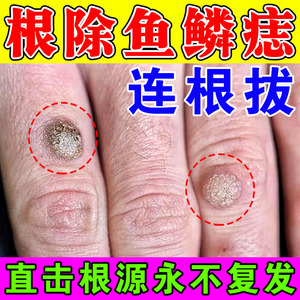 鱼鳞痣去除手指上长鱼鳞疙瘩肉粒扁平疣血胞刺鱼休子去寻常疣神器