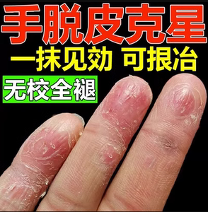 手脱皮严重脱皮专用剥脱性角质松懈症治疗手上起皮干燥手爆皮药膏