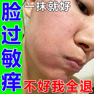 脂溢性皮炎面部脸上过敏皮肤痒药膏修复激素脸鼻翼干燥起皮专用药