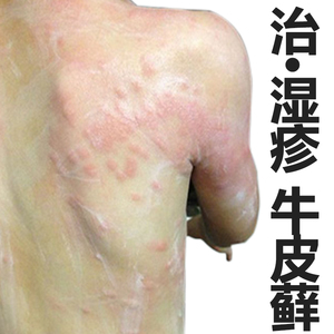 治成人大腿内侧真菌感染阴囊皮肤湿疹止痒去根汗疱疹瘙痒外用膏