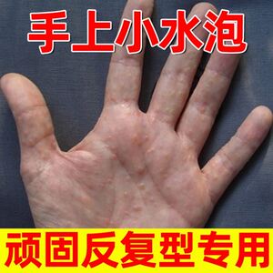 去痒药膏药膏止痒抑菌皮肤儿童湿疹止痒去根婴儿手足癣药膏手足癣