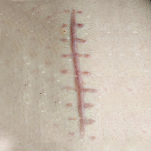 伤疤仿真贴假增生手术后缝针拆线后伤疤假伤口烫伤枪伤剧组化妆皮