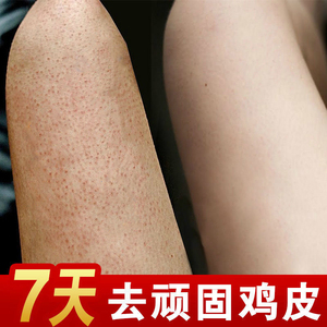 去除鸡皮肤疙瘩毛囊角化角质腿部手臂脸部全身毛周角化身体乳神器
