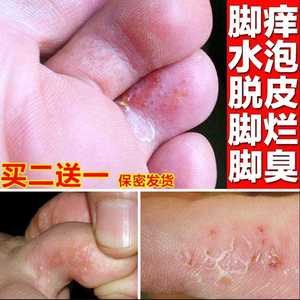擦脚气的藥脚痒止痒膏杀菌喷脚王喷剂南京同仁堂草本祛膏印度