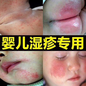 湿疹婴儿专用口水疹宝宝热疹儿童奶藓膏干性皮肤婴幼儿止痒去根霜