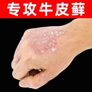 专克牛皮鲜有红斑白色鳞屑掉干皮寻常型银消病瘙痒出血点水膏套装
