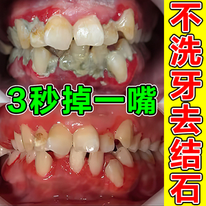 00口腔宝贝淘宝涑爽氯己定漱口液水200毫升牙疼除口臭牙龈肿痛出血