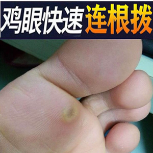 药膏去根寻常疣病毒疣脚底专用药膏去除足部鸡眼瘊子去除94人付款49