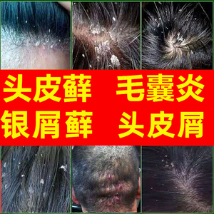 去头癣银屑癣外用头部真菌感染牛皮癣专用的药膏头皮藓头廯洗发水
