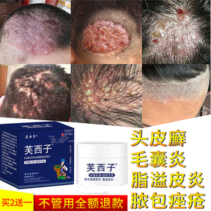 头皮癣专用脂溢性止痒真菌感染去银屑病治疗头部牛皮藓毛炎药膏