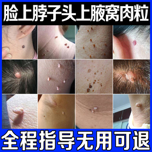 祛肉瘤皮赘去除膏猴子脖子小肉粒疙瘩点丝状尤瘊子瘊疣灵肉痣神器
